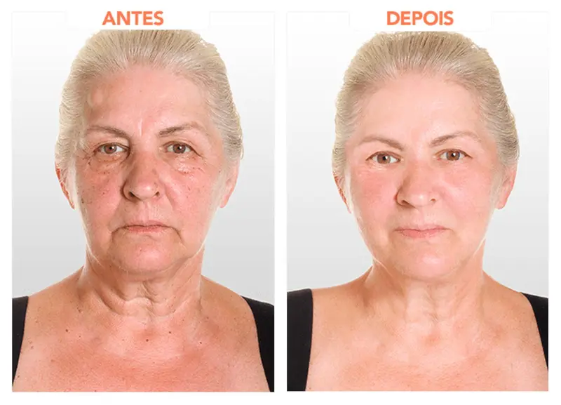 Resultado Berenice A.